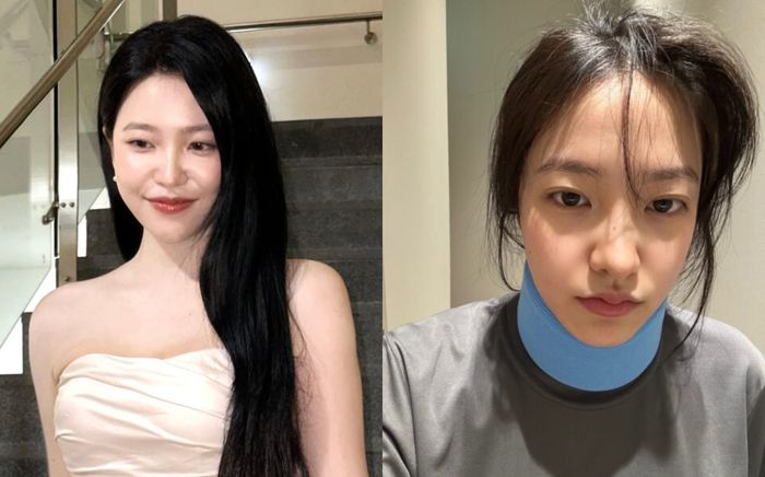 Tình trạng của Yeri (Red Velvet) sau khi bị gãy cổ