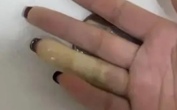 Ngón tay bỗng đổi màu trắng bệch như 'xúc xích', người phụ nữ gặp hiện tượng ít ai ngờ