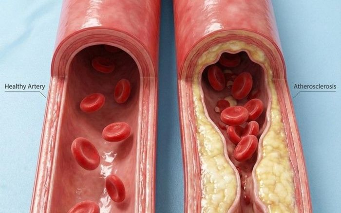 Dấu hiệu cảnh báo mạch máu đang hẹp dần, nguy cơ đột quỵ đến gần