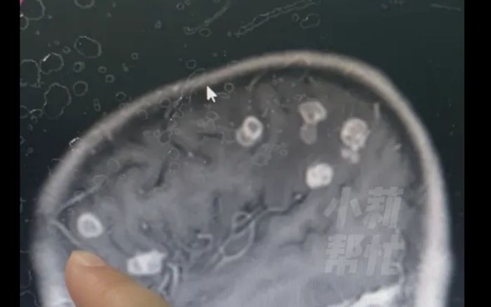 Bé gái 6 tuổi bị sốt suốt 17 ngày sau khi dọn nhà, kết quả kiểm tra khiến bác sĩ sốc