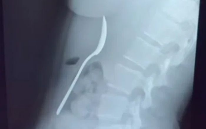 Bị chó cưng bất ngờ nhảy lên người, cô gái nuốt chiếc muỗng dài 17cm vào dạ dày