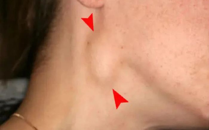 Khi cơ thể xuất hiện dấu hiệu này cần tới bệnh viện ngay kẻo ung thư vòm họng