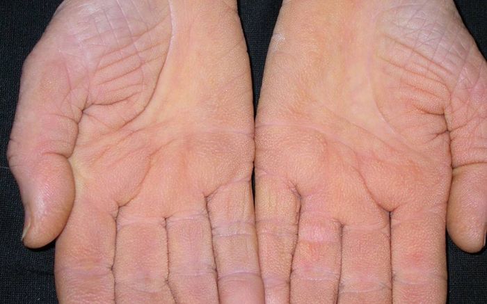 Nếu bàn tay có 3 thay đổi này, cơ thể có thể đang 'lên tiếng' về sức khỏe