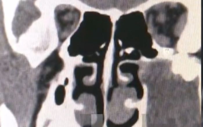 Bé trai 15 tuổi mặt sưng, miệng méo, đi chụp CT bác sĩ phát hiện sự thật bất ngờ