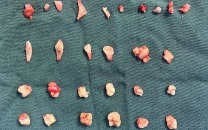 Cô gái đau bụng dữ dội khi tập thể dục, bác sĩ 'sốc' khi lấy ra 24 chiếc răng trong bụng