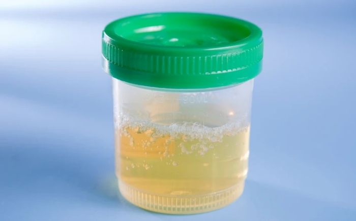 Những dấu hiệu ở nước tiểu vào buổi sáng có thể phản ánh tình trạng sức khỏe