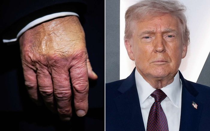 Báo cáo sức khỏe của ông Trump hé lộ nguyên nhân đôi bàn tay thường xuyên bầm tím