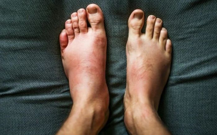 5 biểu hiện cho thấy thận có thể đang suy yếu, nhiều người chỉ phát hiện khi đã ở giai đoạn muộn