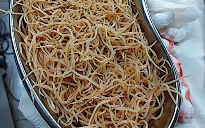 Bé trai đau bụng 3 ngày liên tục, bác sĩ kinh hoàng khi lấy ra thứ bên trong