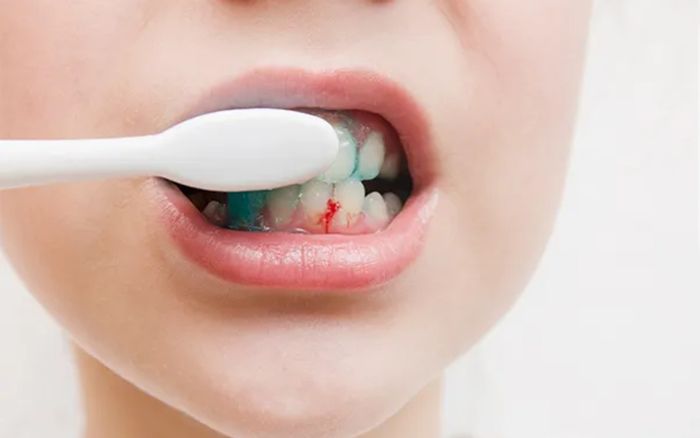 Những sai lầm khi đánh răng khiến răng ngày càng yếu dù vệ sinh đều đặn