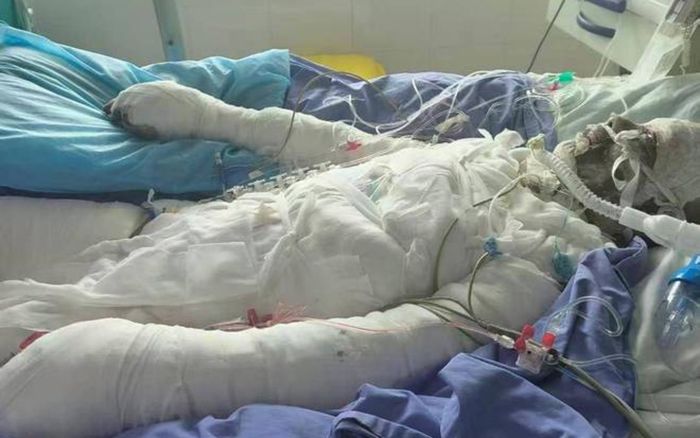 Chàng trai 20 tuổi hiến da cứu cha bị bỏng 95% sau vụ nổ khí gas, câu nói gây xúc động