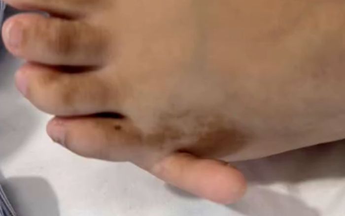 Cô gái có 6 ngón ở cả hai bàn chân, ngoại hình tuổi 17 khiến ai cũng xôn xao