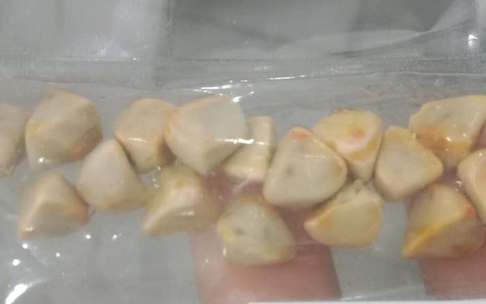 Uống trà đá mỗi ngày trong suốt 10 năm, người phụ nữ tích tụ cả 'ổ' sỏi thận