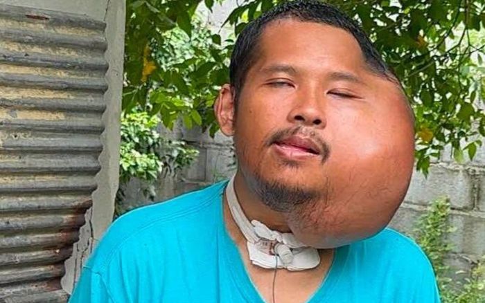 Người đàn ông bị biến dạng khuôn mặt kinh hoàng sau khi dùng tăm xỉa răng