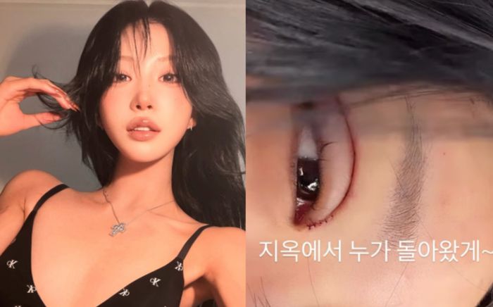 Sau 3 tháng kết hôn, Choi Joon Hee lộ đôi mắt sưng húp