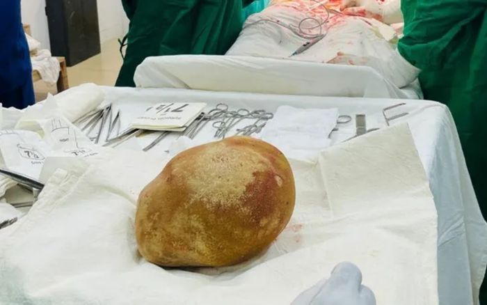 Người đàn ông 55 tuổi nhập viện vì đột quỵ, bác sĩ lấy ra viên sỏi nặng 3,1kg