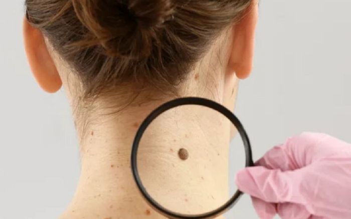 Những dấu hiệu cảnh báo ung thư da, nhiều người chủ quan thường hay bỏ qua