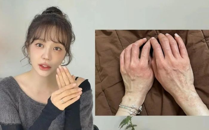 Yoon Eun Hye bị dị ứng nghiêm trọng, hai tay sưng đỏ rồi lan khắp mặt