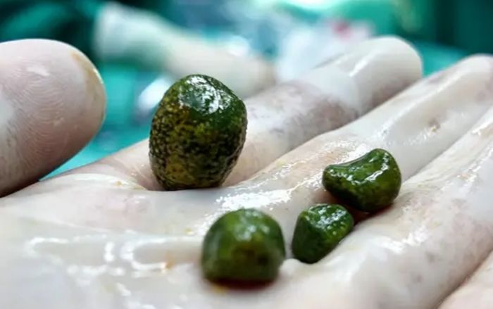 Cô gái 28 tuổi có 4 viên 'ngọc lục bảo' trong túi mật, bác sĩ chỉ ra thói quen nhiều người mắc