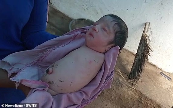 Bé gái chào đời không có cả tay và chân