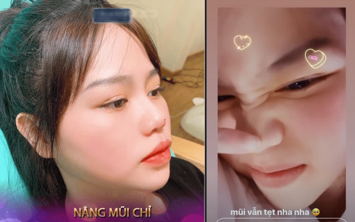 Bị đồn nâng mũi, sửa mặt, bạn gái Quang Hải lập tức lên tiếng