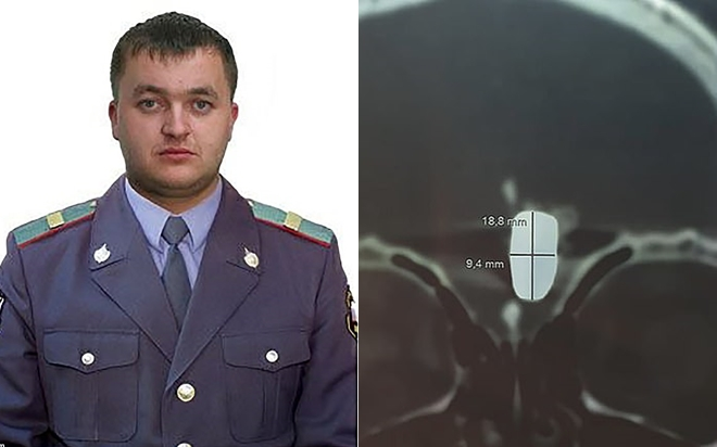 Cựu cảnh sát sống chung với viên đạn găm trong não suốt 10 năm