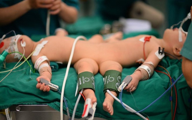 Cứ 12 tiếng đồng hồ, các bác sĩ sẽ họp giao ban tình hình sức khỏe hai bé Trúc Nhi - Diệu Nhi.