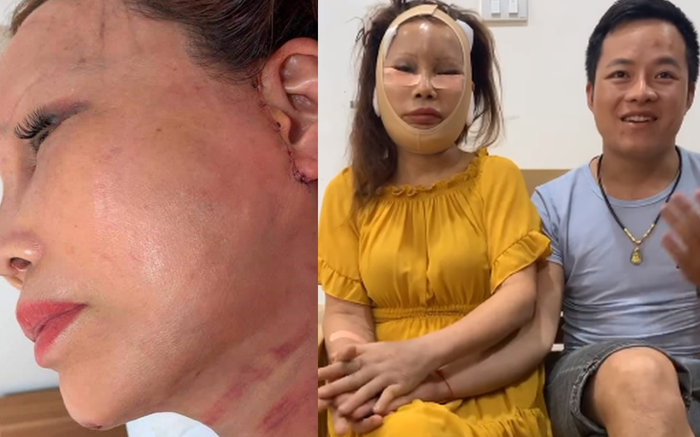 Nhan sắc sau 1 tháng phẫu thuật của cô dâu '62 tuổi' ở Cao Bằng: Sẹo chằng chịt, mặt sưng phù