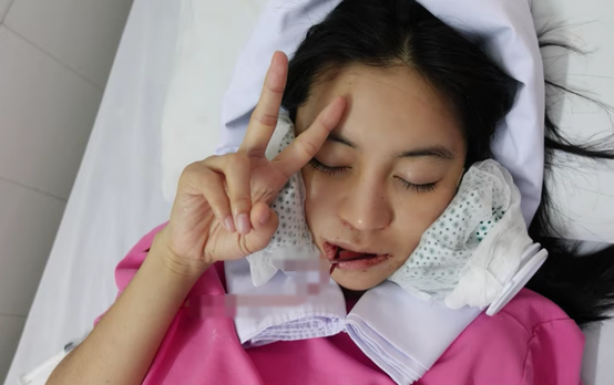 Gò má trở thành bộ phận tiếp theo để hotgirl Trang Anna 'đại tu nhan sắc'