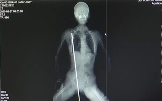 Bị thanh thép xuyên dọc thân, người phụ nữ sống sót thần kỳ