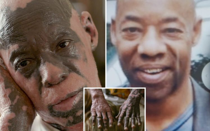 Người đàn ông mắc bệnh lạ khiến làn da loang lổ như đám cháy rừng