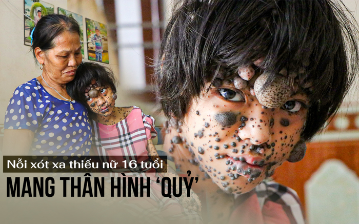 Nỗi xót xa thiếu nữ 16 tuổi mang thân hình 'quỷ', sống u sầu bởi ai nhìn cũng khiếp sợ