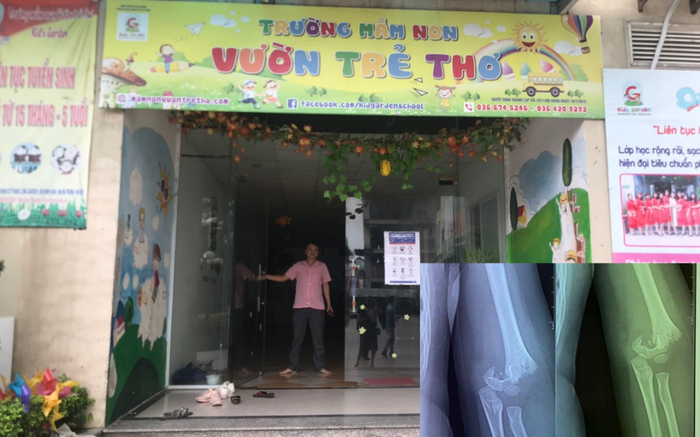 Mẹ bé gái 5 tuổi bị gãy lìa xương khuỷu tay ở trường mầm non: 'Con tôi đang hoảng loạn vô cùng'