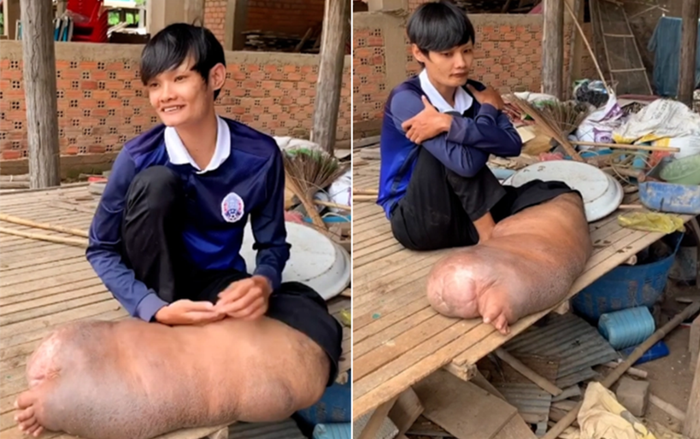 Bị muỗi đốt, chàng trai phải sống với một bên chân sưng phù 'quái dị' suốt 21 năm