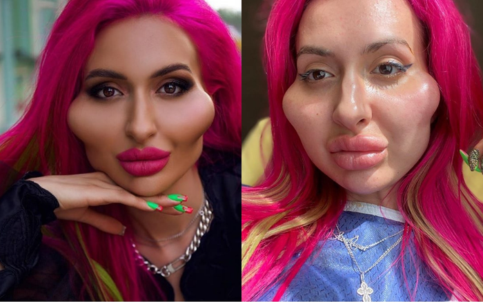 'Nghiện' tiêm filter suốt 4 năm, nàng mẫu có 'gò má cao nhất thế giới' vẫn thấy chưa 'đủ đô'