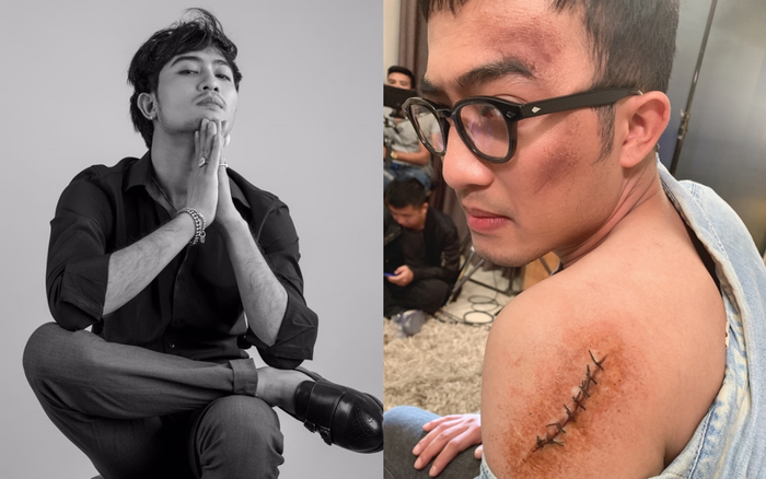 Doãn Quốc Đam khiến fan tá hỏa với hình ảnh mặt mũi bầm dập, vai trái bị khâu gần 10 mũi
