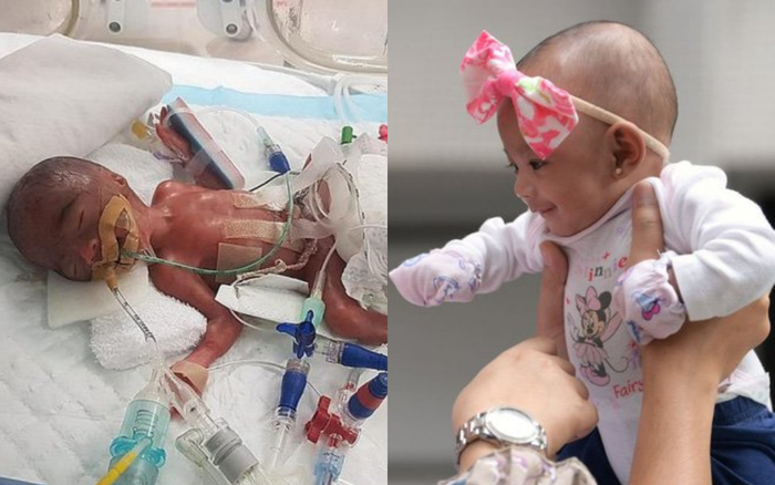 Bé gái sinh non nặng vỏn vẹn bằng quả cà tím giờ ra sao sau 7 tháng chào đời