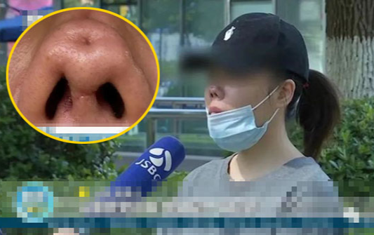Chi hơn 80 triệu đồng để phẫu thuật thẩm mỹ, nữ streamer cay đắng nhận lại chiếc mũi với 4 lỗ