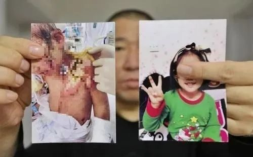 Sống cùng mẹ ruột và bạn trai của mẹ vài tháng, bé gái 6 tuổi bị bẻ răng, dội nước sôi