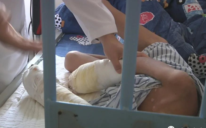 Bé trai 7 tuổi bị bố ruột bạo hành, 2 bàn tay bị hoại tử tới mức có thể phải cắt cụt