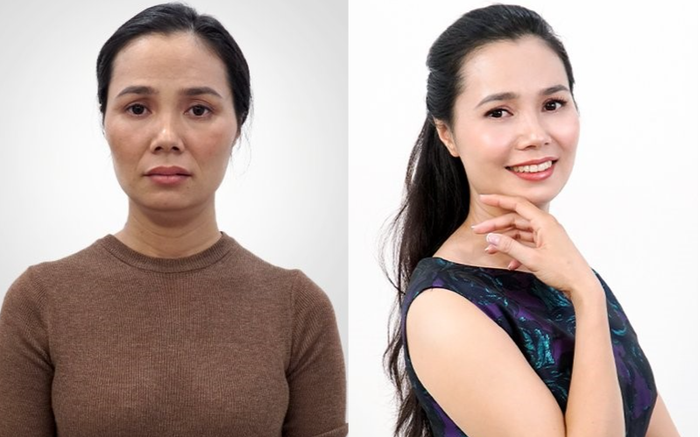 Phụ nữ Việt phát sốt với công nghệ căng chỉ Be - Young chuẩn y khoa hiện đại từ Hàn Quốc