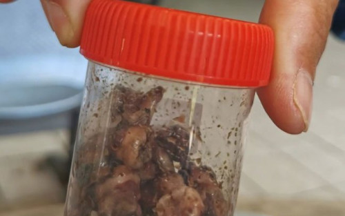 Người phụ nữ mất mạng sau khi nhổ 20 chiếc răng sâu cùng lúc