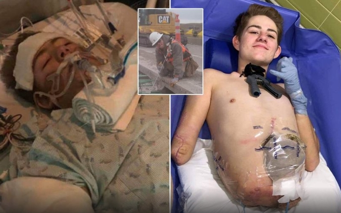 Bị xe nâng 4 tấn nghiền nát nửa người, chàng công nhân xây dựng sống sót kỳ diệu