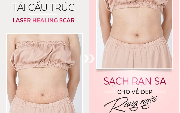 Khám phá Công nghệ trị rạn tái cấu trúc Healing Scar 'hot' nhất hiện nay