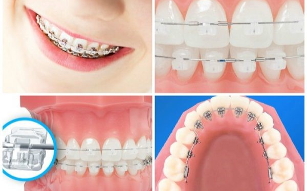 Niềng răng mặt trong - Đỉnh cao của niềng răng mắc cài