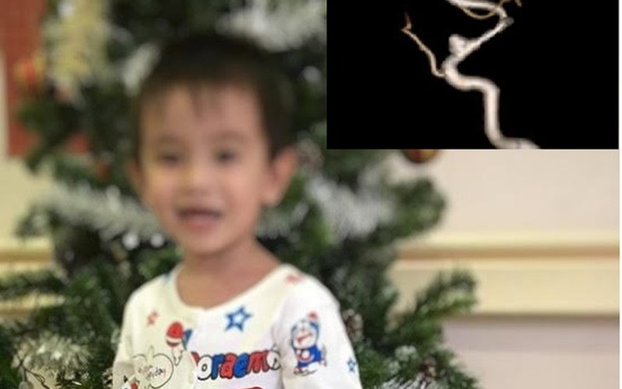 Cứu sống thành công bé trai 3 tuổi bị đột quỵ trong lúc đang chơi với bạn