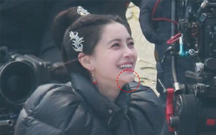 Angelababy lộ biến chứng phẫu thuật thẩm mỹ sau những tranh cãi với Huỳnh Hiểu Minh?