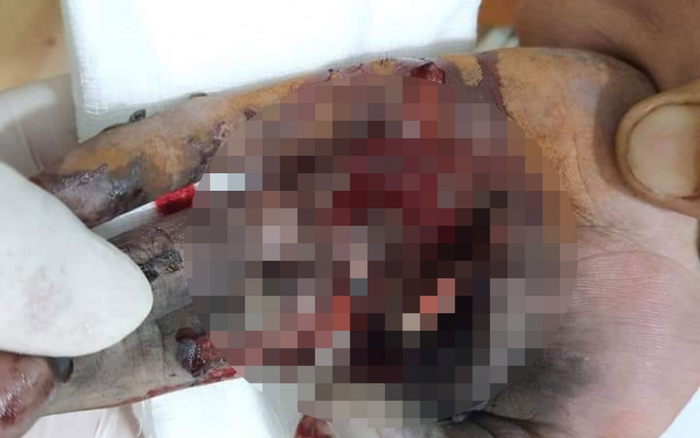 Vừa sạc điện thoại vừa chơi game, thiếu niên bị nổ nát bàn tay