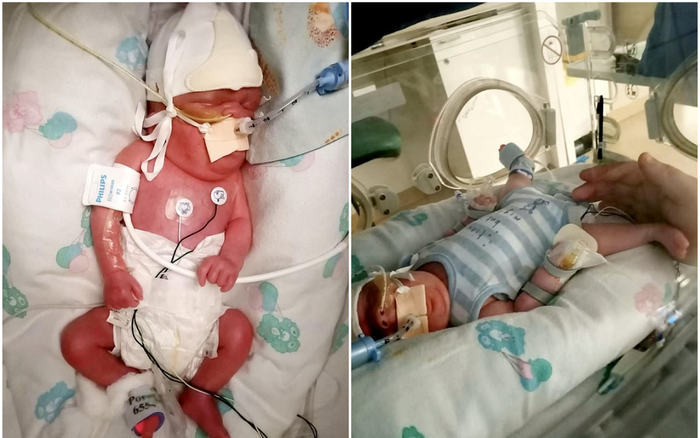 Em bé sinh non 15 tuần, nặng chưa tới 1kg sống sót thần kỳ dù mắc Covid-19, nhiễm trùng huyết và E.coli