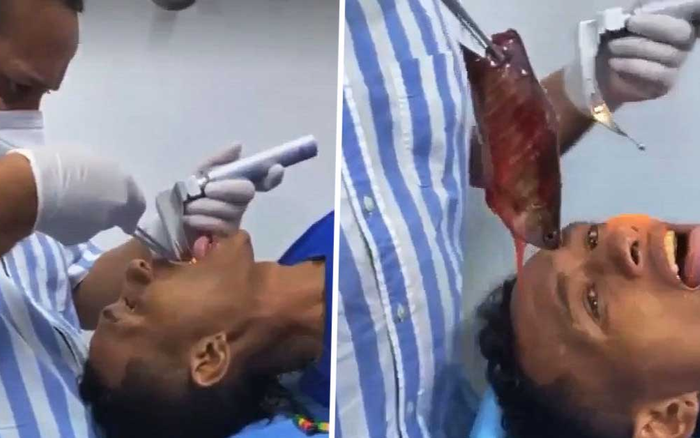 Chàng trai suýt chết vì con cá 18 cm kẹt trong cổ họng theo cách 'khó đỡ'
